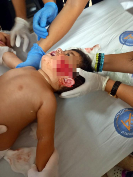 11 aylıkken pitbull saldırısına uğrayan minik Sadrettin, anne kelimesinden önce ‘acıyor’u öğrendi