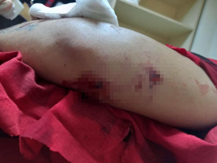 11 aylıkken pitbull saldırısına uğrayan minik Sadrettin, anne kelimesinden önce ‘acıyor’u öğrendi