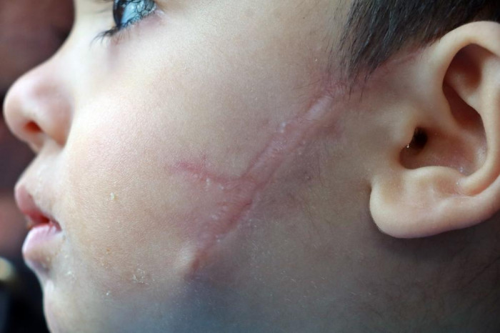 11 aylıkken pitbull saldırısına uğrayan minik Sadrettin, anne kelimesinden önce ‘acıyor’u öğrendi