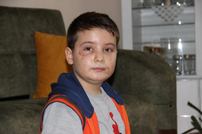 Köpek saldırısında ölümden dönen Mert: “Köpek görünce anne ve babamın arkasına saklanıyorum”