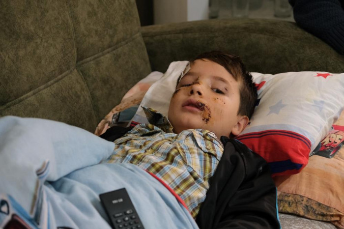 Köpek saldırısında ölümden dönen Mert: “Köpek görünce anne ve babamın arkasına saklanıyorum”