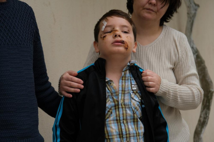 Köpek saldırısında ölümden dönen Mert: “Köpek görünce anne ve babamın arkasına saklanıyorum”