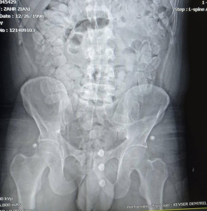  Faslı turistin midesinden 1,5 kilo esrar çıktı